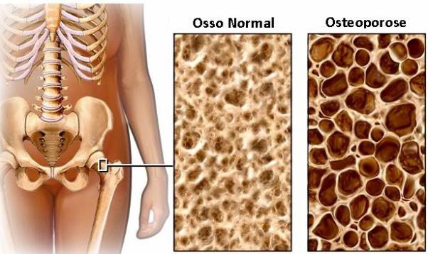 Osteoporose - Sintomas, tratamentos e prevenção